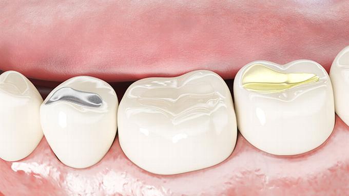3D illustration of silver white and gold fillings in teeth